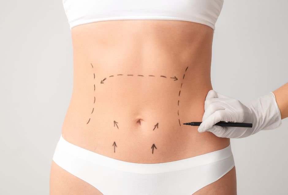 Abdominoplasty