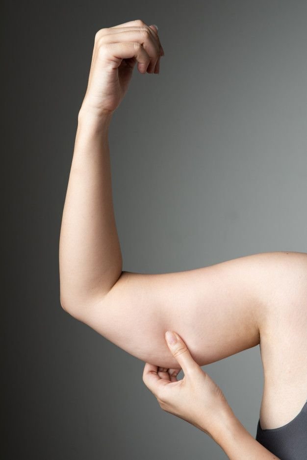 Brachioplasty