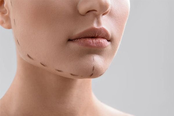 Chin Implant