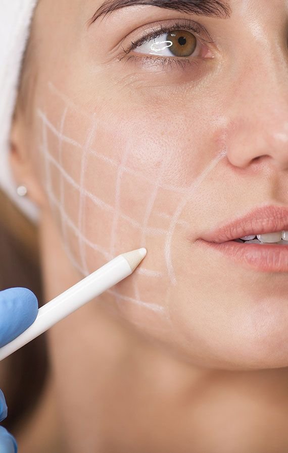 Facelift