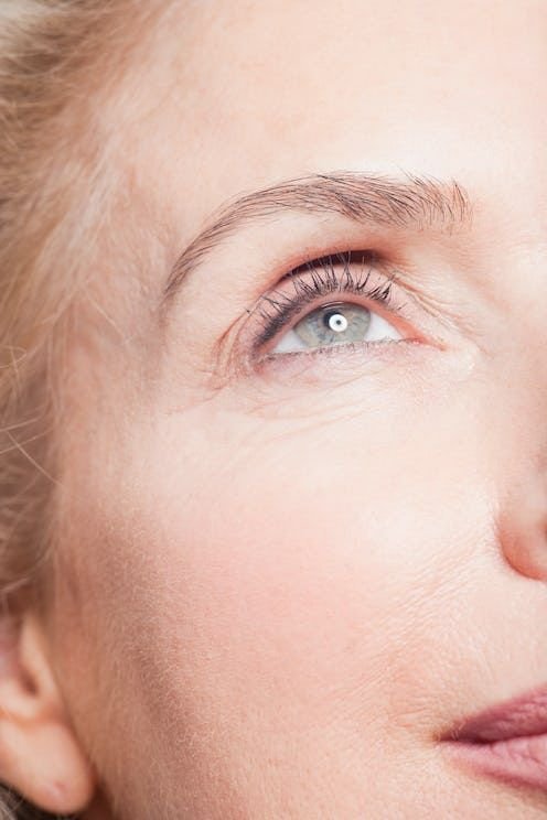Lower Blepharoplasty